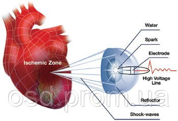 Ударно-волновая терапия сердечно-сосудистых заболеваний Кардиоспек (Cardiospec)