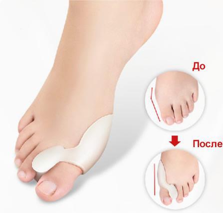 Лечебный фиксатор большого пальца Valgus Pro Medicus (Вальгус Про) - пара, для коррекции косточки (VF)
Лечебный фиксатор большого пальца Valgus Pro Medicus (Вальгус Про) - пара, для коррекции косточки (VF)