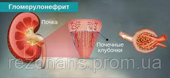 

Хронический гломерулонефрит