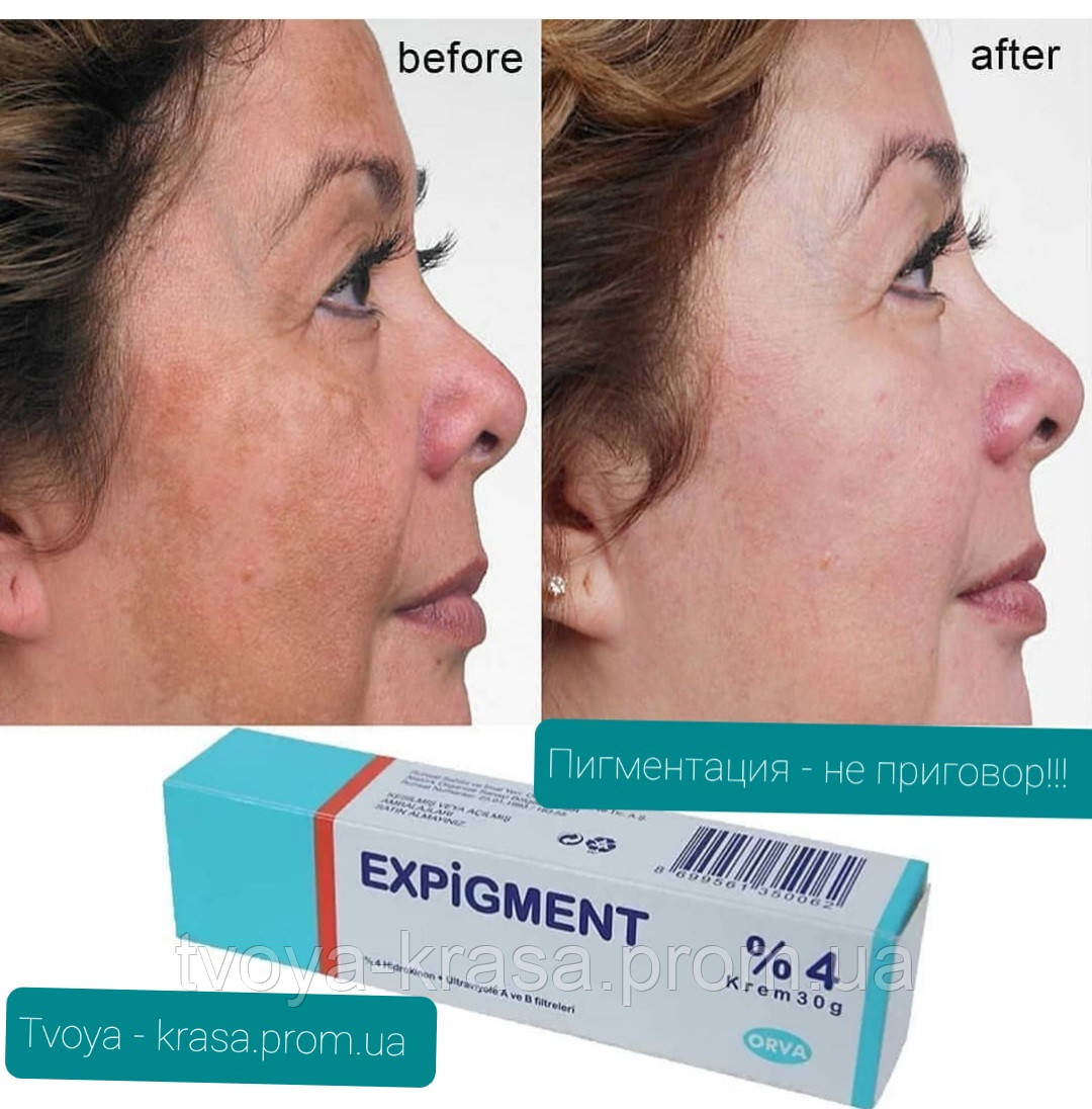 Турецкий отбеливающий крем expigment